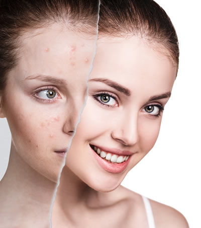 Acne Treatment in Atlanta