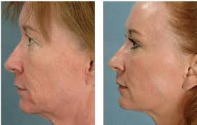 Lunch Time Face Lift & Scar Treatment