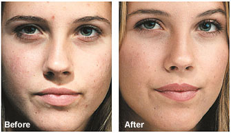 How to Reduce the Appearance of Acne Scarring