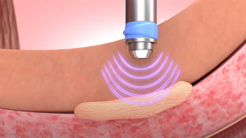 GAINSWave Treatment in Brookhaven