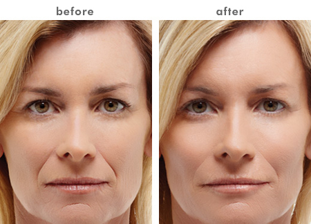 Harnessing the Power of Radiesse for Youthful Skin