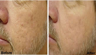 Is Laser Genesis Skin Therapy Right for You? 