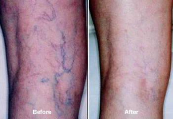 Vein Therapy in Brookhaven